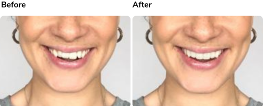 Before and after Invisalign treatment