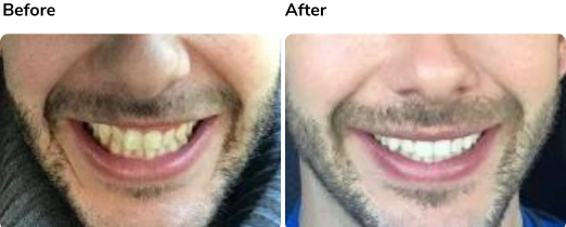 Before and after Invisalign treatment