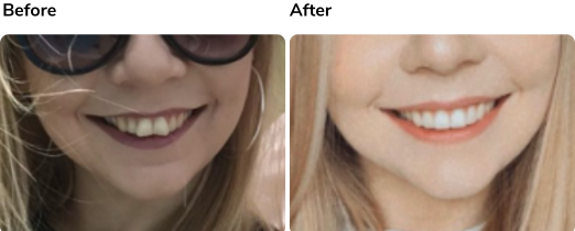 Before and after Invisalign treatment