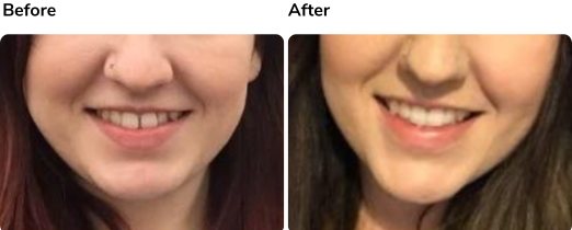 Before and after Invisalign treatment